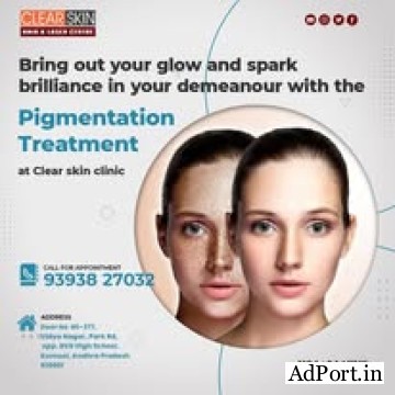 portwine stain treatment in india || Clear Skin