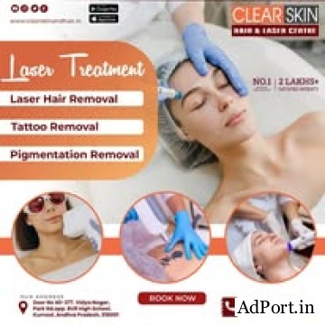 Laser Treatment For Birthmark Removal In India