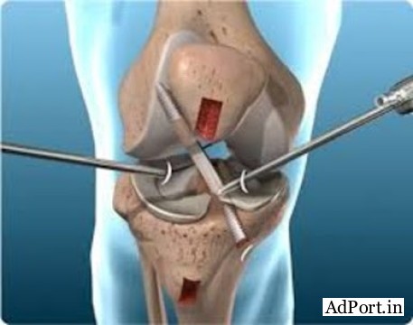 Orthopedic Care You Can Trust in Vaishali Nagar Dr Arvind Asopa