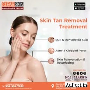 best vbeam laser treatment in india