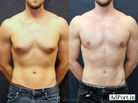 Get Expert Gynecomastia Surgery in Delhi at Affordable Cost
