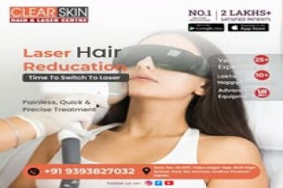best vascular laser treatment in india