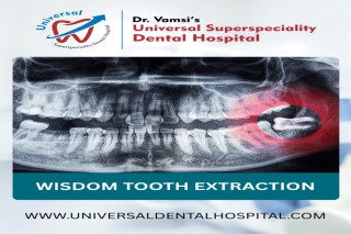  Wisdom Tooth Extraction A Complete Guide for Pain-Free Recovery