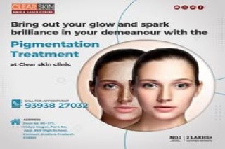 portwine stain treatment in india || Clear Skin
