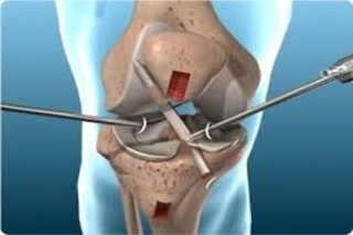 Orthopedic Care You Can Trust in Vaishali Nagar Dr Arvind Asopa