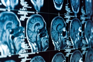 Neuro Oncology Surgery | Dr. Keval Shukla