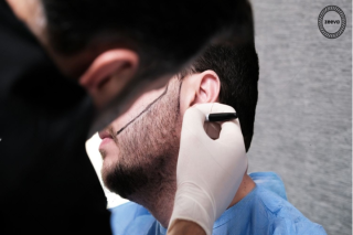 Advanced Beard Hair Transplant Near Me Solutions for Natural-Looking Facial Enhancement