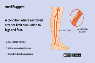 peripheral vascular intervention hitec city