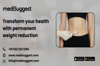 Best bariatric surgery in banjara hills
