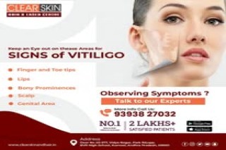 Laser Treatment For Birthmark Removal In India