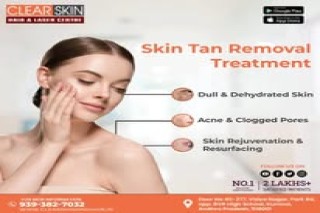 best vbeam laser treatment in india