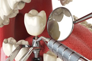 Affordable Dental Clinic in Delhi for Complete Oral Care