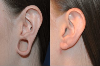 Get Expert Earlobe Treatment in Delhi at Affordable Cost