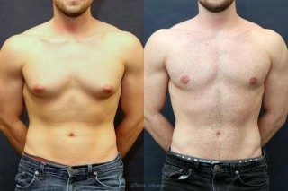 Get Expert Gynecomastia Surgery in Delhi at Affordable Cost